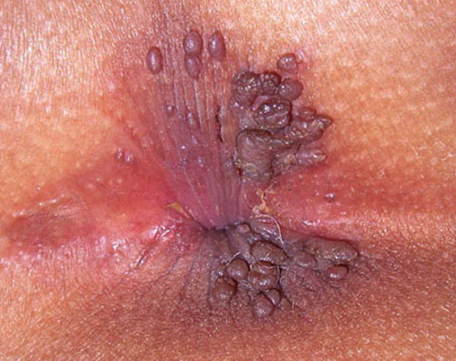 16 hình ảnh bệnh sùi mào gà ở nam nữ giới, miệng, hậu môn và cách chữa trị